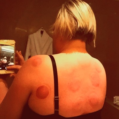 The aftermath of my cupping treatment - notice the large purple circle under my left shoulder!